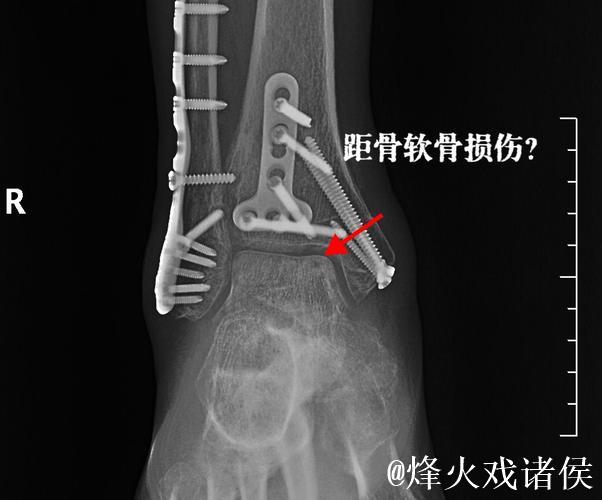 加福德：右脚踝感觉好多了，这是长时间以来感觉最好的一次